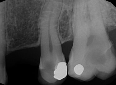 Výchozí stav – kazy zasahující do dřeně zubu